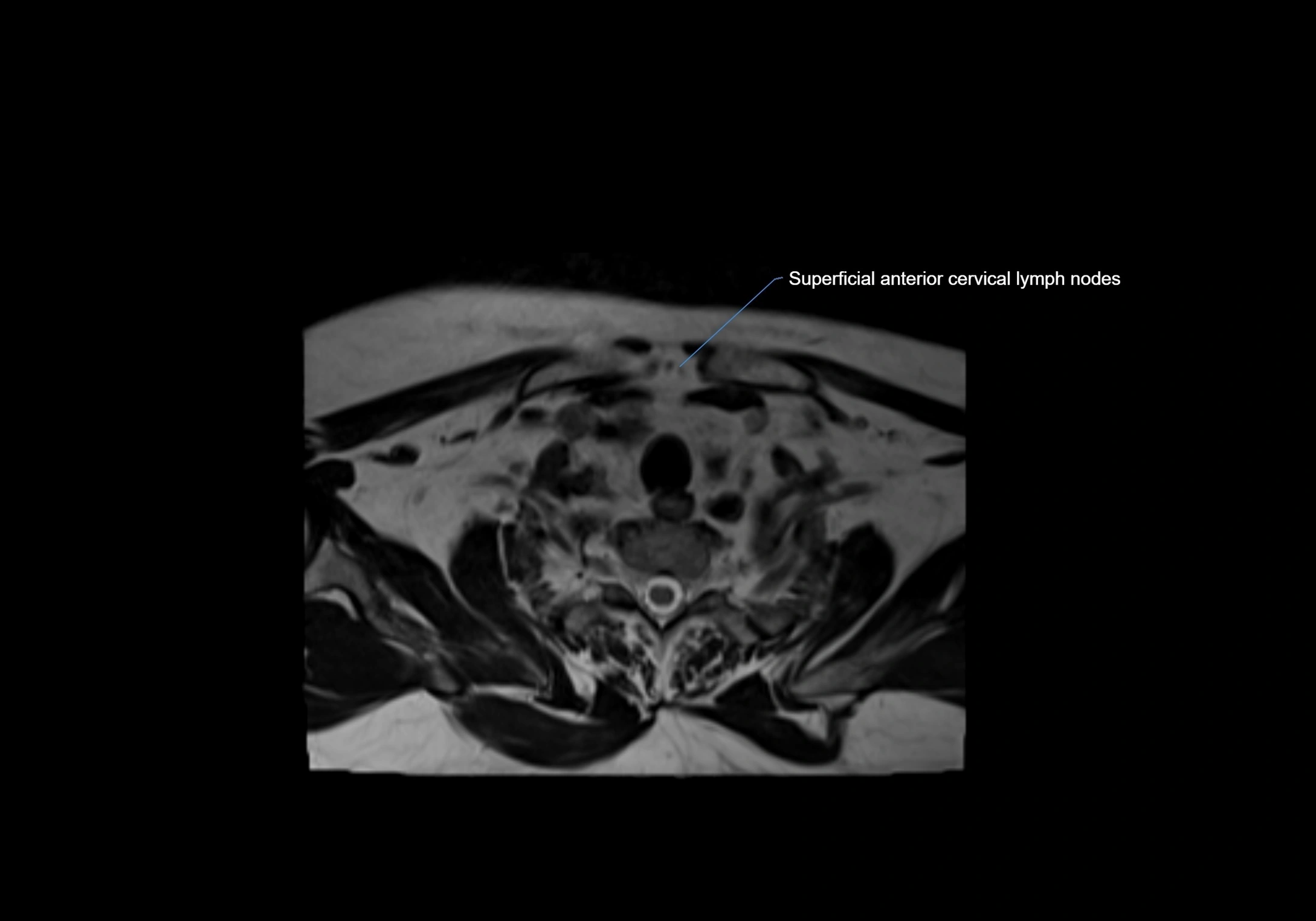 Neck axial  lymph node cross sectional MRI anatomy 3T MRI  image-img-00001-00092.webp
